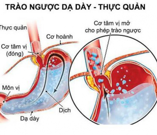 trao-nguoc-da-day 1